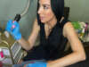 Scar Camouflage: Enhancing Confidence through Cosmetic Tattooing
